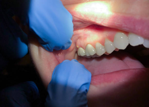 Best Chipped Tooth Repair Near Me  in Salisbury, NC